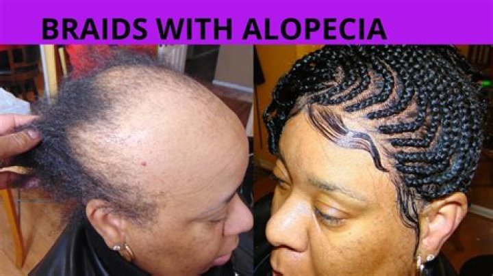 Alopecia Braiders Near Me: Finding The Right Support For Hair Loss