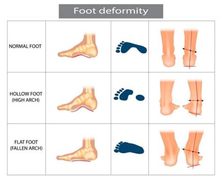 The Enigmatic World Of Flat Foot Singing Meaning