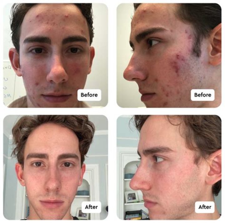 Transformational Journey: Accutane Back Acne Before And After