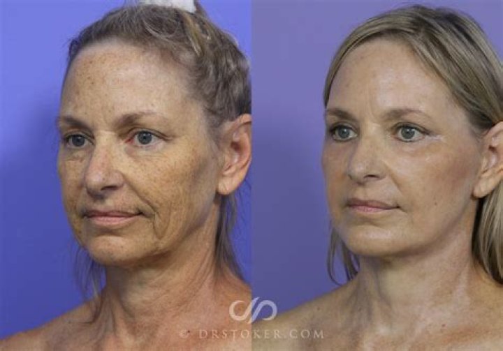 Transformations Of The Face: Before And After High Cortisol Levels