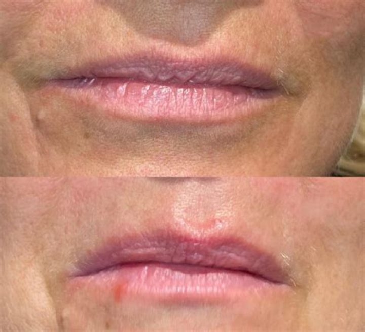 When Beauty Treatments Go Awry: The Gone Wrong Botox Upper Lip Flip Before And After